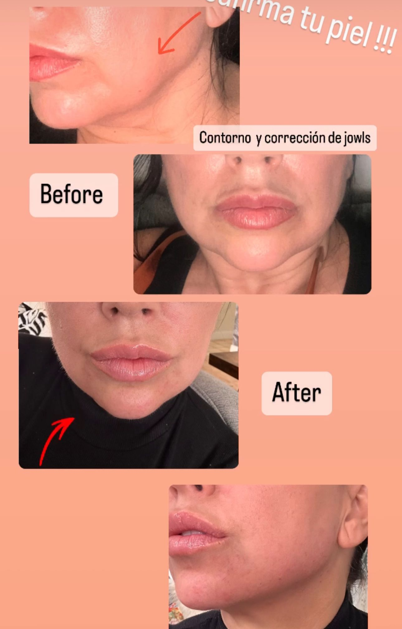 hyaluronic acid filler before and after