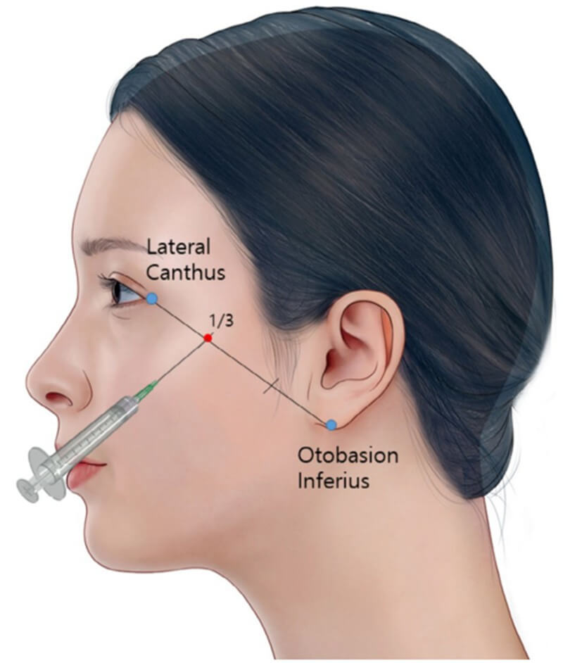 Plla injection targets the zygomatic arch ligament