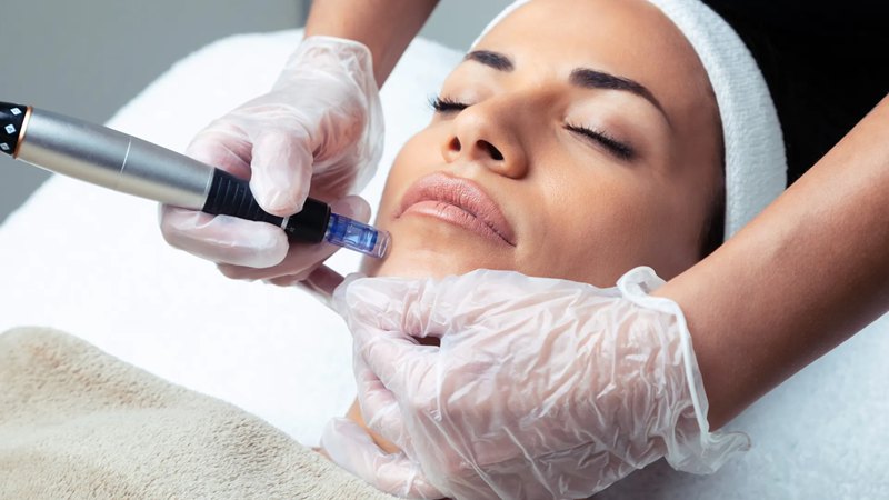 microneedling with exosomes side effects