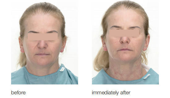 pdo smooth threads neck before and after (3)