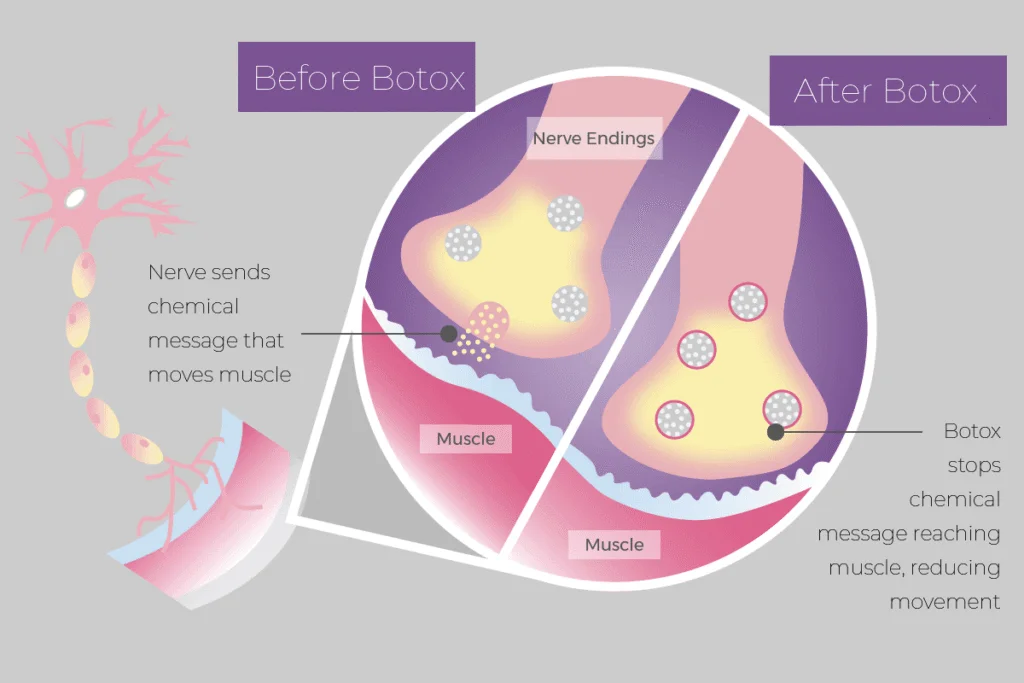 How Does Botulinum Toxin Type A Work?