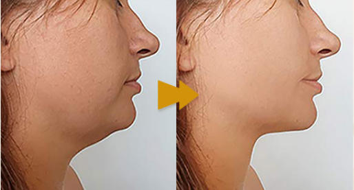 Fat Dissolving Injections Before and After Face