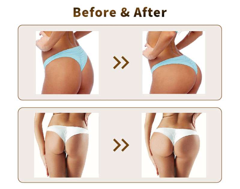 Macrolite Hyaluronic Acid Buttock Injections Before and After
