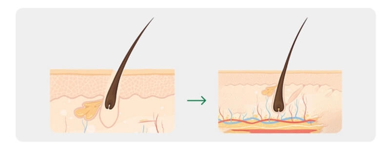 Enhancing Scalp Blood Circulation & Nutrient Delivery