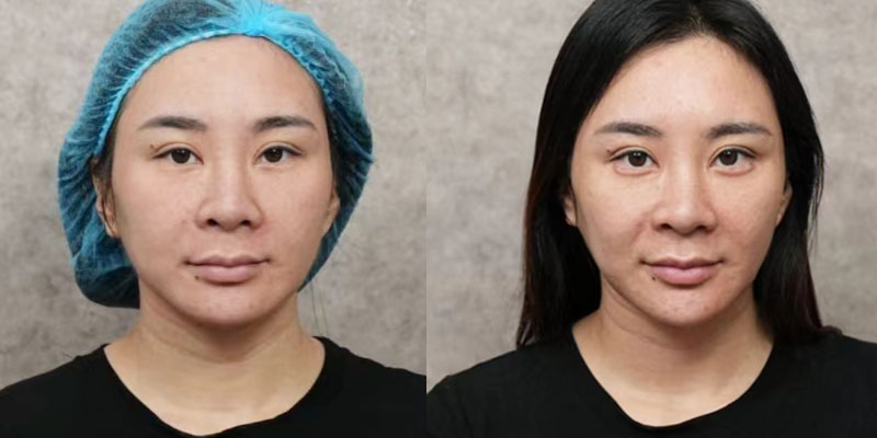Prejvua skin booster before and after