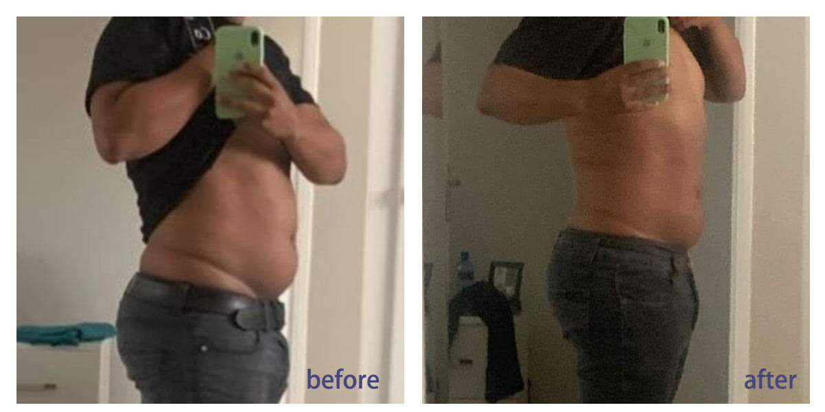 fat dissolving injections before and after (1)