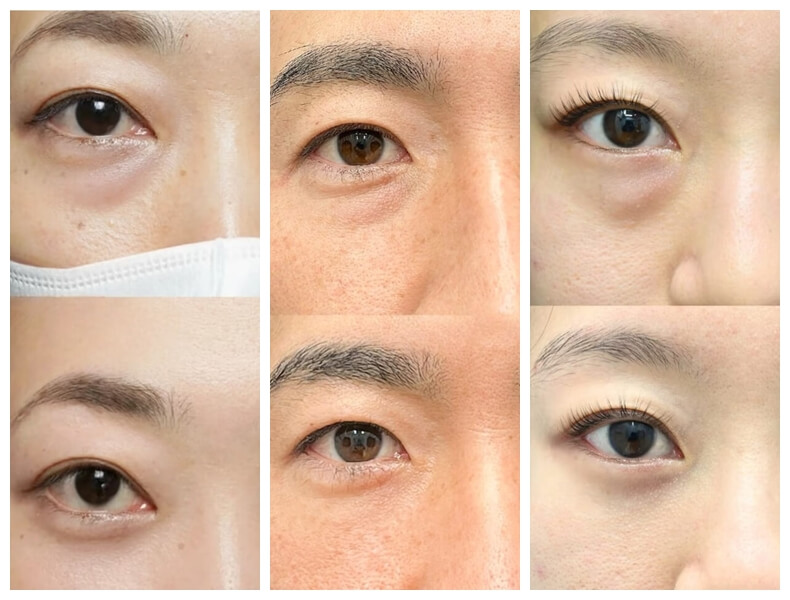 polynucleotides for under eye bags before and after