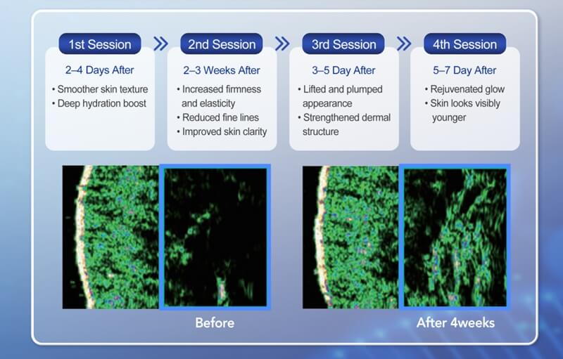 pnpure polynucleotide treatment timeline