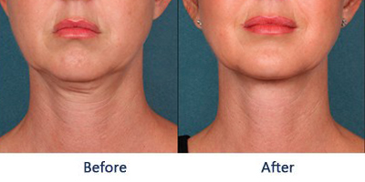 Mesotherapy and biorevitalization