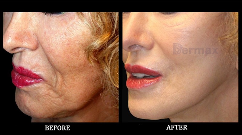 There Is a Great Demand for Non-surgical Aesthetics, Magik PDO Thread Lifts Are a New Way to Achieve Instant Skin Tightening (3)