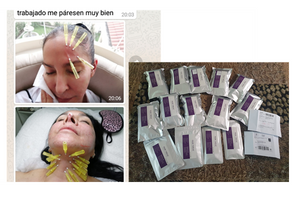 Non Surgical Pdo Thread Lift Online Supply