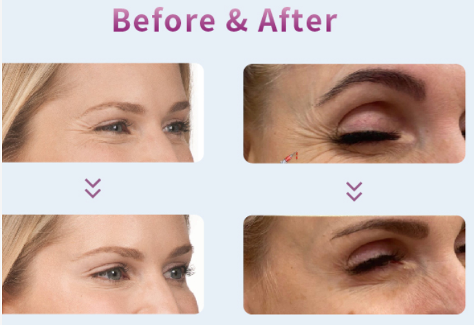 Botulinum toxin overdose