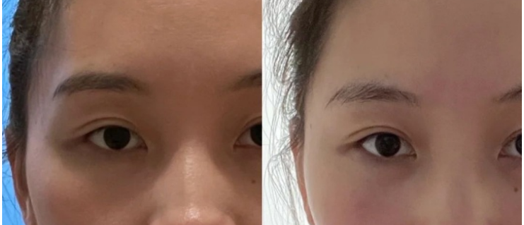 temple hyaluronic acid