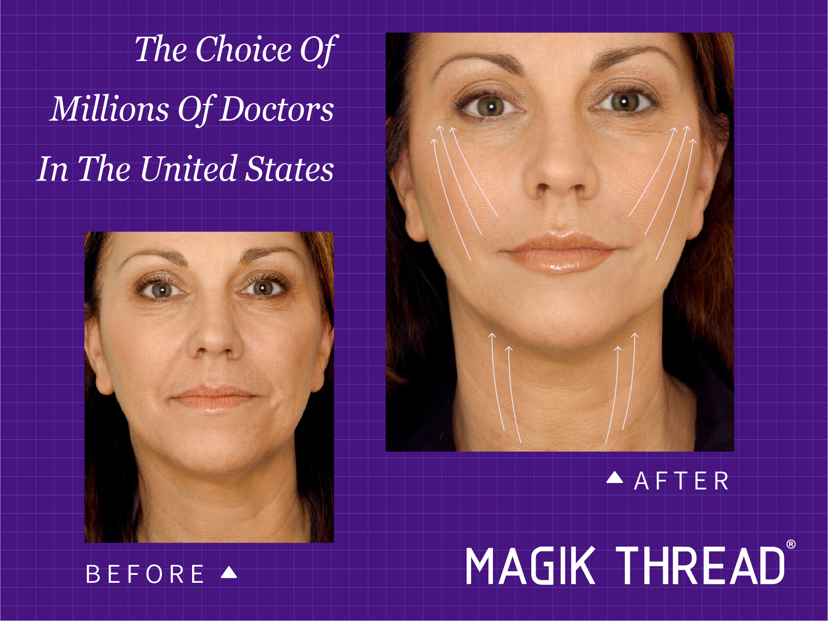 How long does a PDO thread lift last Is pdo safe