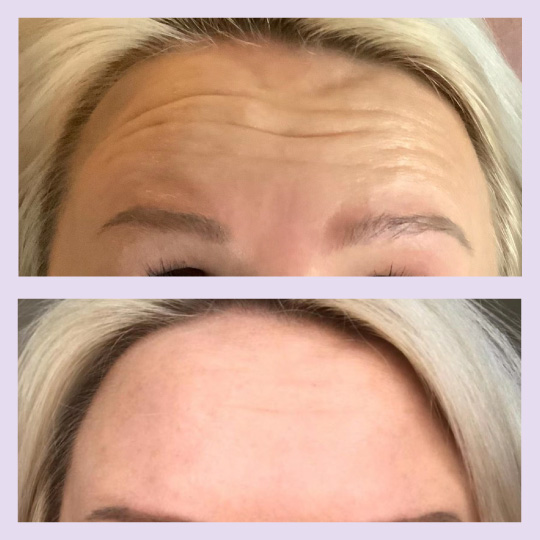 Aqua Secret Vs Sotorior botulinum toxin