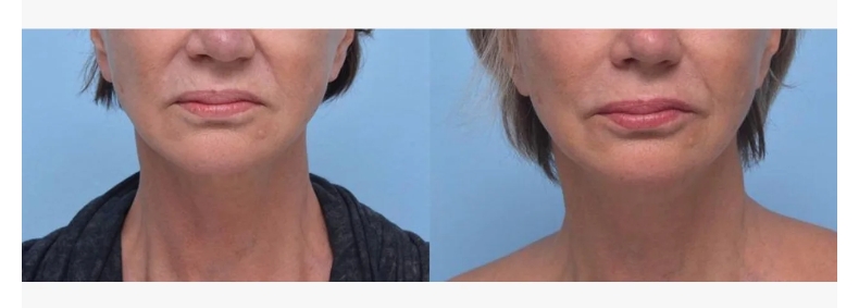 Botulinum Toxin For Laugh Lines