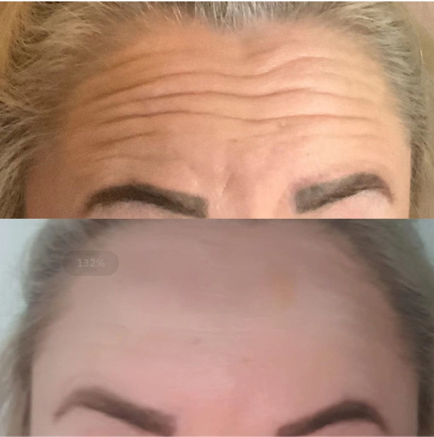 Magik Thread Pdo Thread Before And After Dermax