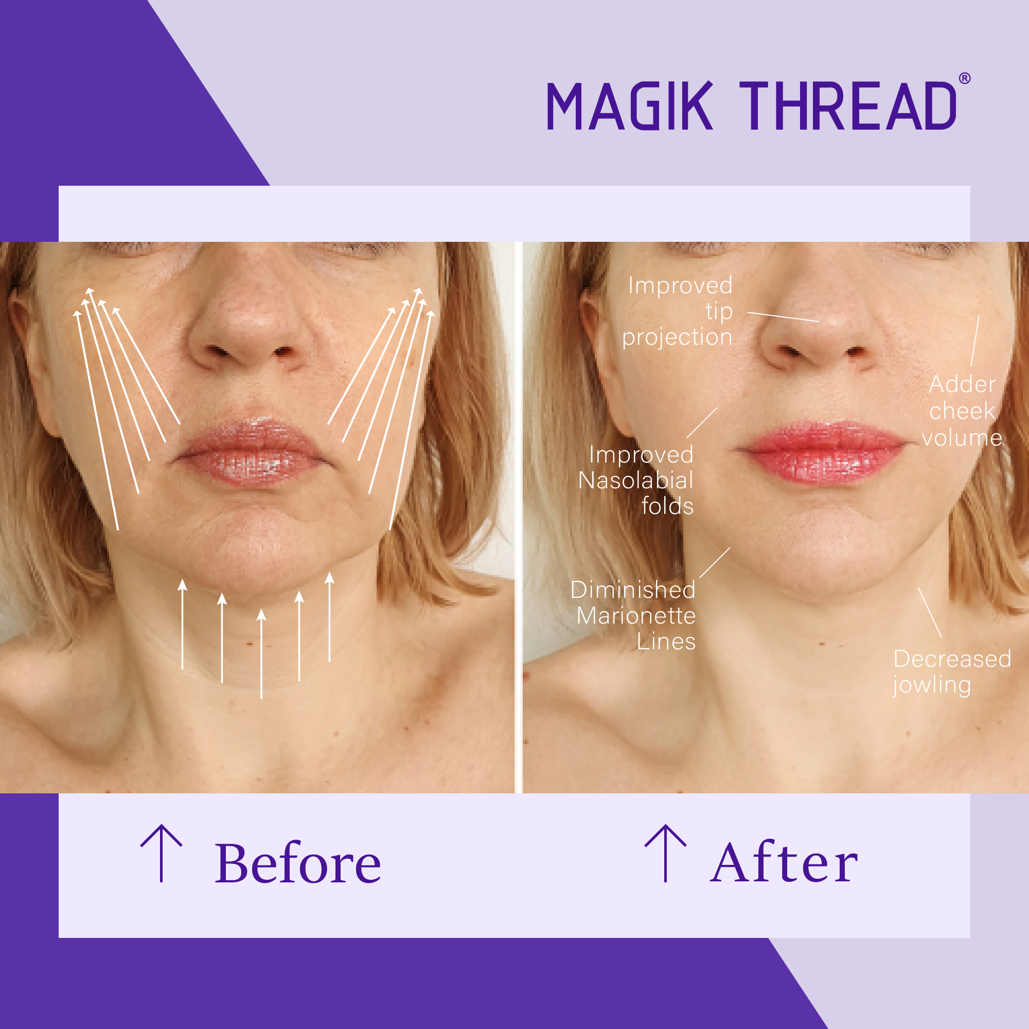PDO Thread Lift for The Neck: Before And After