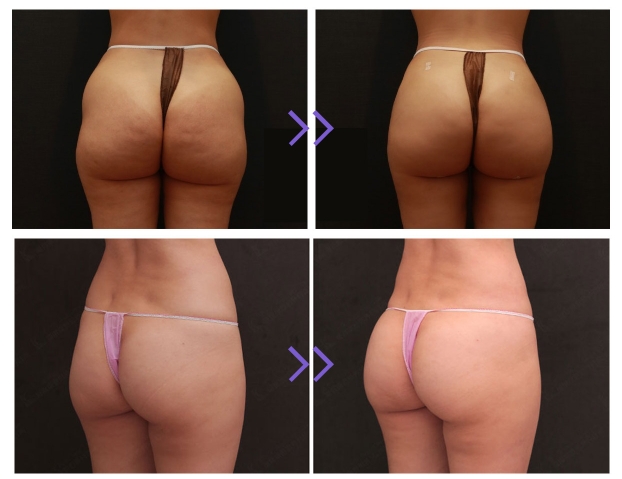 Devolux PLLA Filler for Buttocks Before and After