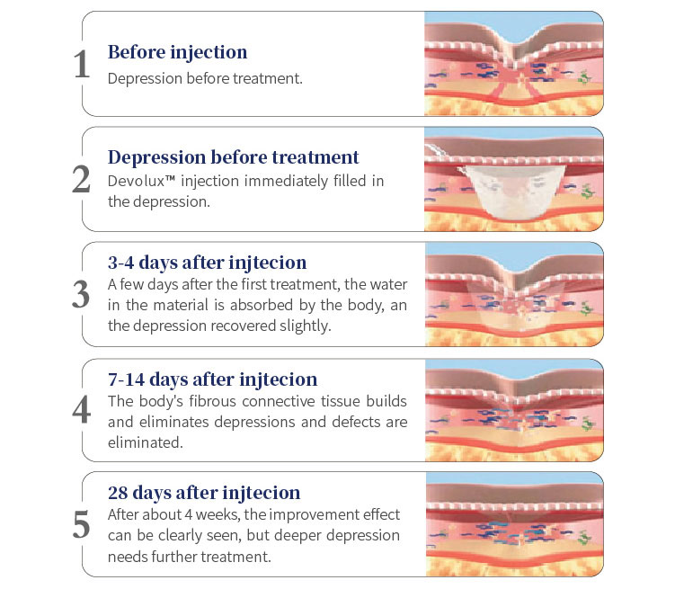 poly-l-lactic acid filler for buttocks