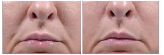 Before and After of CHArmacy Filler Injection
