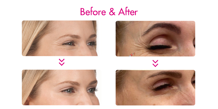 Botulinum Toxin before and after use