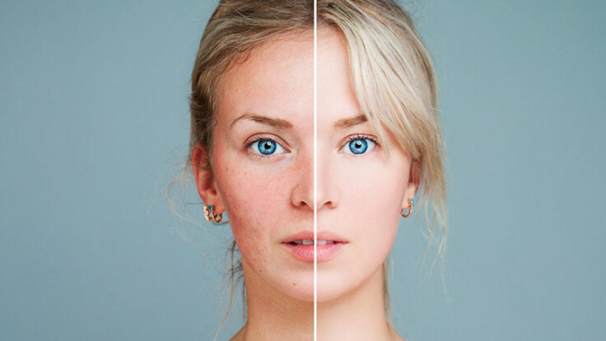 mesotherapy-for-face.jpg