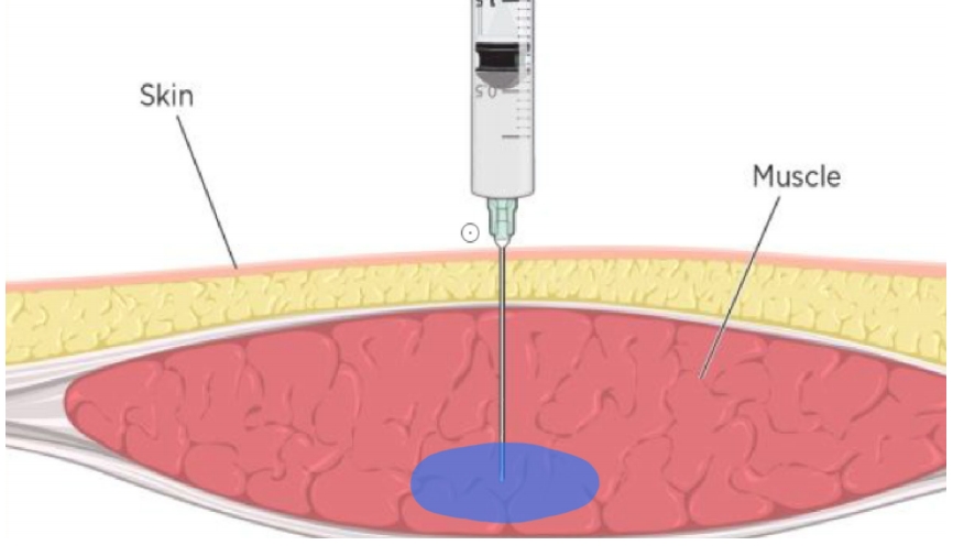 hyaluronic acid dermal filler for breast injection (2)