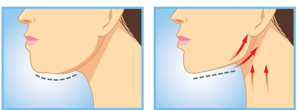 pdo thread lift double chin before and after