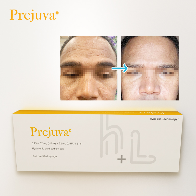 profhilo injections before and after