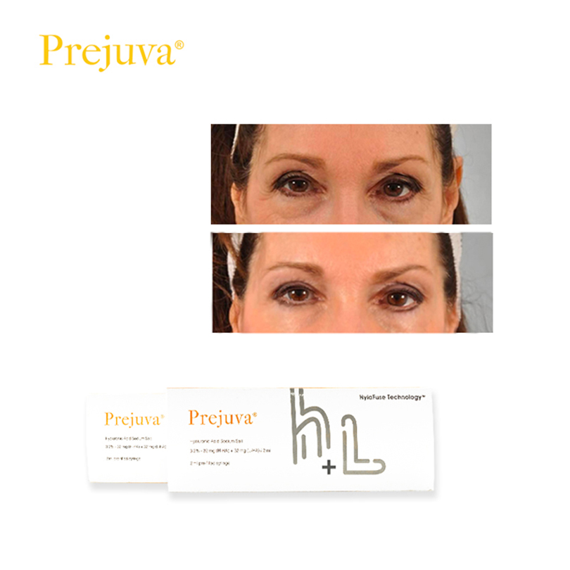 profhilo injections before and after