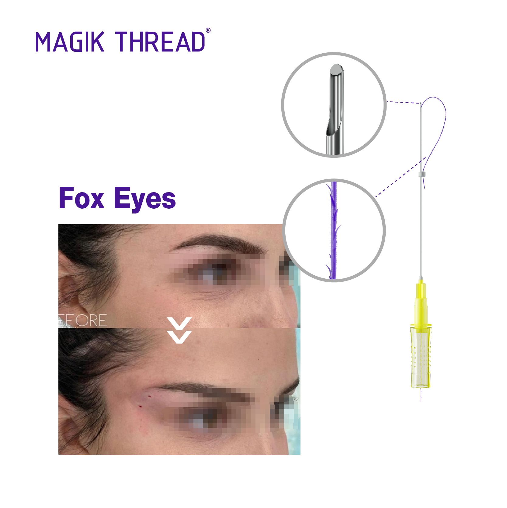 Magik Thread Fox Eyes Pdo Thread Lift
