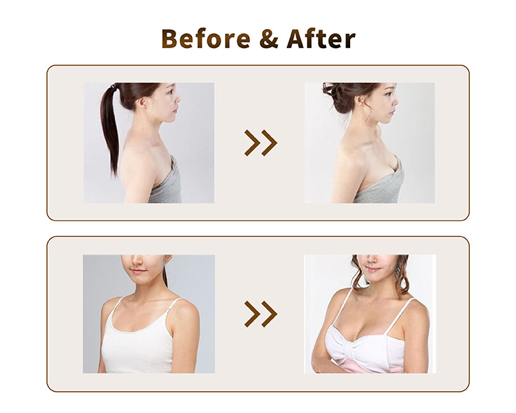 dermal filler for sale