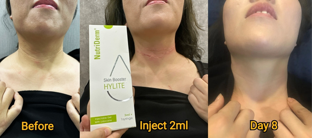 NutriDerm Skin Booster vs. Rejuran Skin Booster