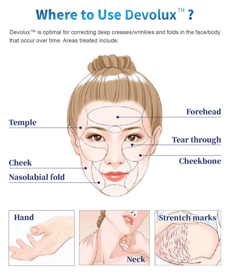 devolux plla dermal filler treatment areas
