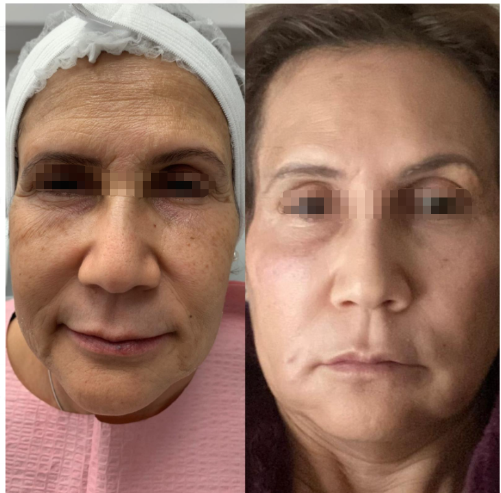 hyaluronic acid filler before and after