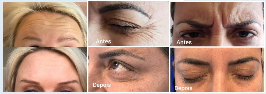 korean botulinum toxin before and after (2)