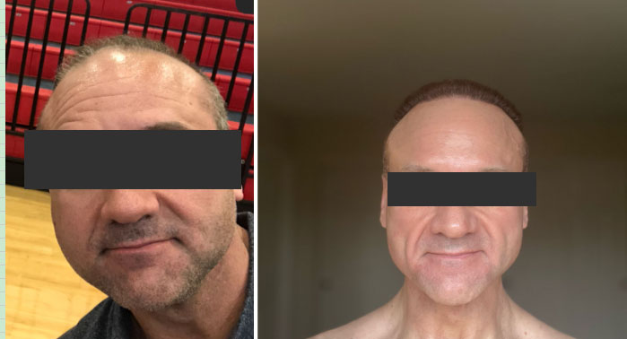 Botulinum-Toxin-&-PDRN_02