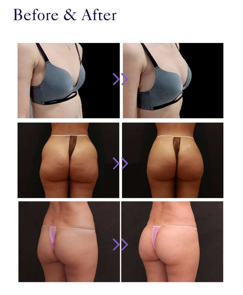 Korea Body PLLA Filler before and after