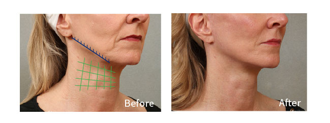 pdo smooth threads neck before and after