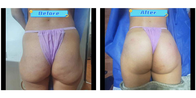 Butt Injections Before and After patients 4