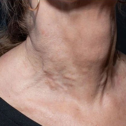 calcium hydroxylapatite filler side effects.jpg