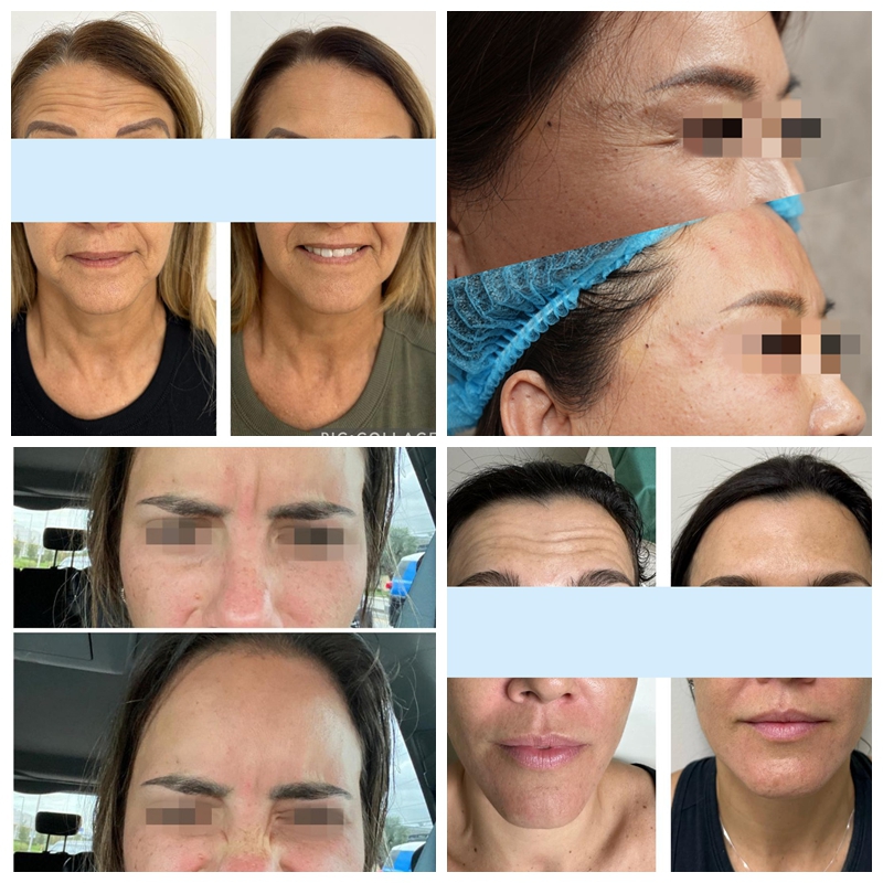 Botulax Before & After