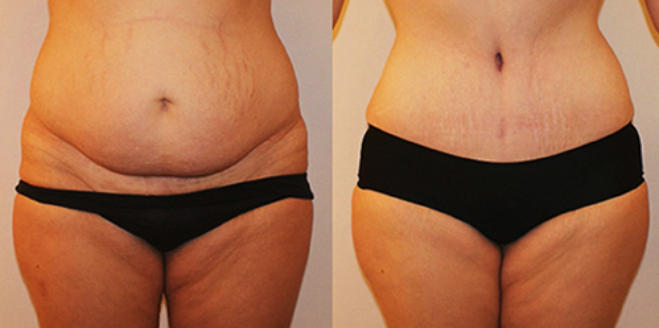LipoGo Abdominal Fat Dissolving Injections before and after