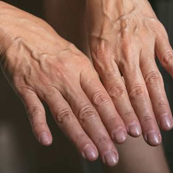 PLLA Filler Treatment for Aging Hands