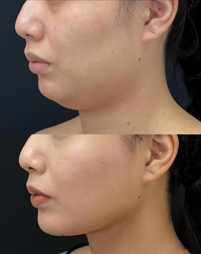 caha filler for chin before and after pics