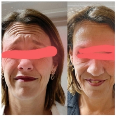 Botulax for face lift