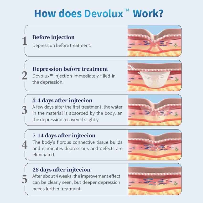 Do you know about devolux PLLA?