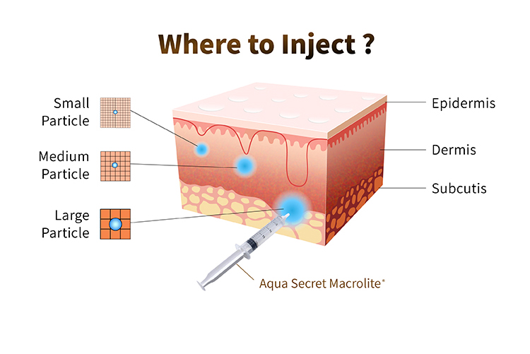 dermal filler breast augmentation