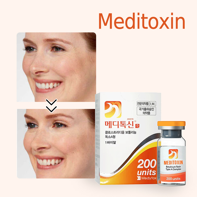 Is Bruising After Botulinum Toxin Dangerous